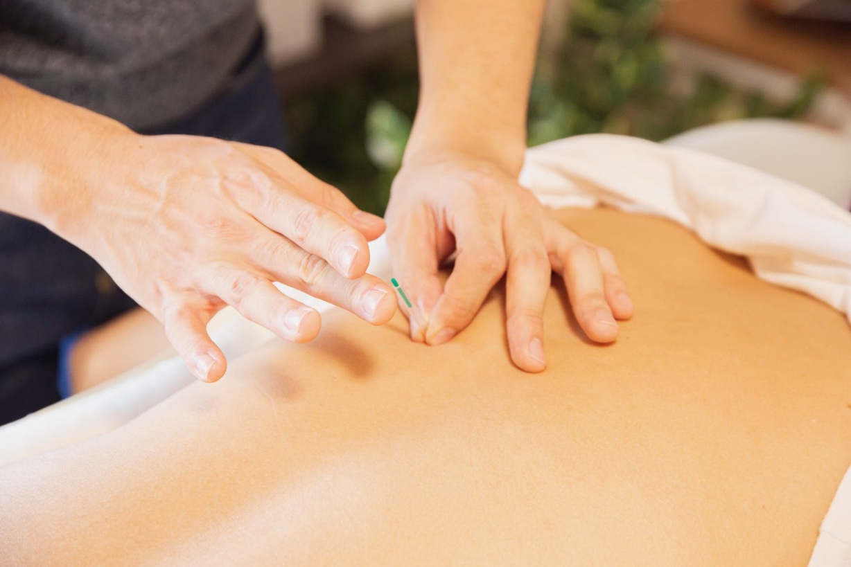 ACUPUNCTURE SURREY1